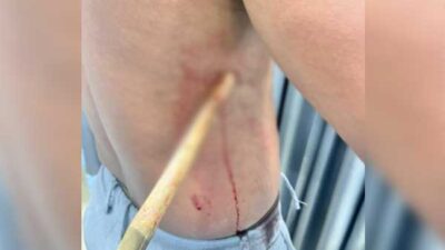 Anak panah tertancap di rusuk kanan Brimob Timika