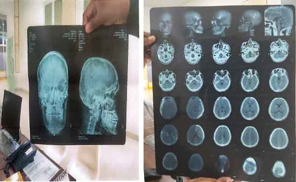 Anak Buah Dikeroyok, Wajah Retak: Dugaan Kekerasan Sadis Warnai Barak Brimob Biak 3 LBH KYADAWUN Biak Bukti Visum Bripda Corneles Imbir