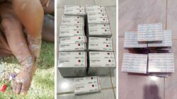Infeksi Kulit Melonjak, Dinkes Papua Tengah Utus Tim ke Distrik Mewoluk Puncak Jaya 6 Dinkes PT Kasus Infkesi Kulit di Puncak Jaya