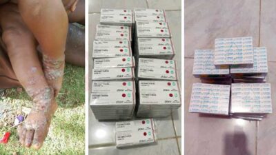 Infeksi Kulit Melonjak, Dinkes Papua Tengah Utus Tim ke Distrik Mewoluk Puncak Jaya 20 Dinkes PT Kasus Infkesi Kulit di Puncak Jaya