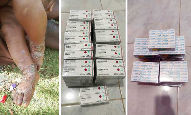 Dinkes PT Kasus Infkesi Kulit di Puncak Jaya